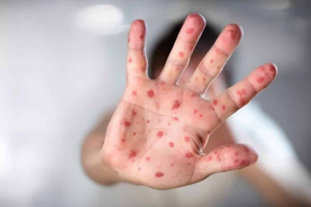 З початку року від кору в Україні померли 18 осіб