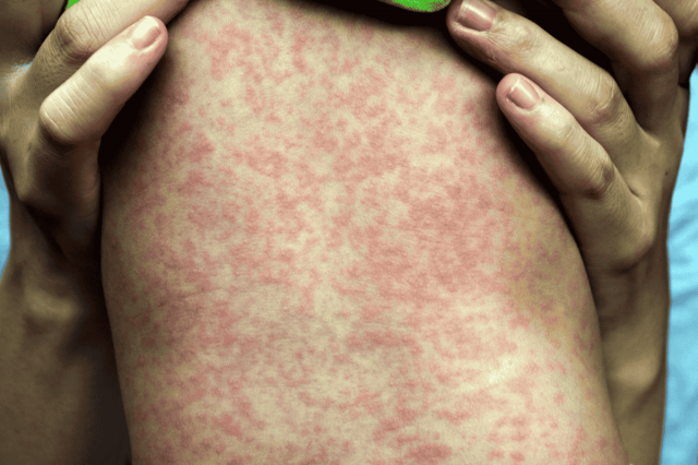 Over 57,000 measles cases recorded in Ukraine since year-start
