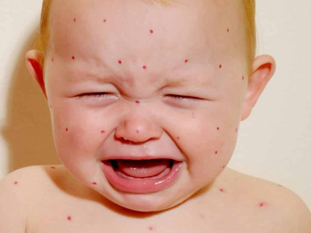 Корь атакует Украину